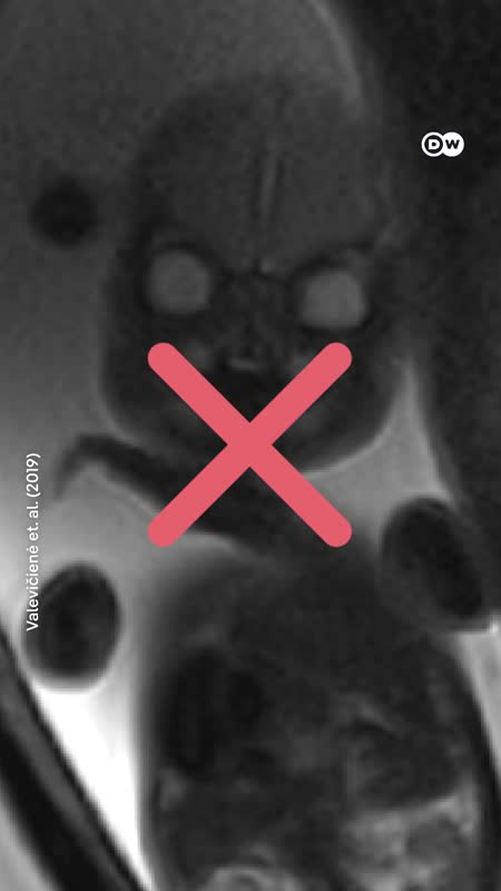 Kenapa Hasil MRI Janin Ini Terlihat Kayak Alien?